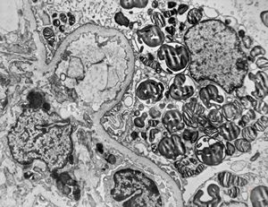 M,27y. | sea-blue histiocyte syndrome M,27y. | sea-blue histiocyte syndrome